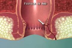 Obat Fistula Ani Tanpa Operasi